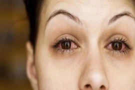 15 nguyên nhân khiến mắt bạn thường xuyên bị đỏ