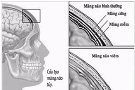 Lao màng não, thể lao nguy hiểm