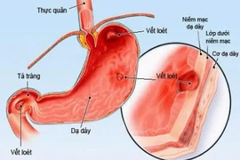 Infographic: 8 món ăn người bị viêm dạ dày cần tránh xa