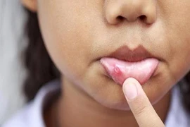 6 cách tự nhiên chữa lở miệng