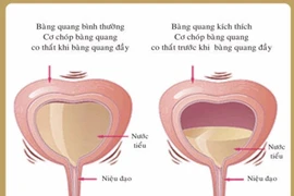 Đi tiểu nhiều - bệnh gì?