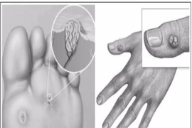 Mụn cóc và thuốc trị