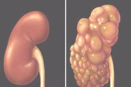 Bệnh thận đa nang và các biến chứng
