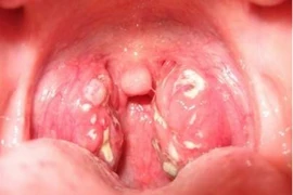 Viêm họng hạt nguy hiểm như thế nào?