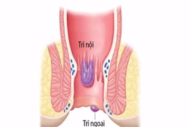 Nhận biết bệnh trĩ