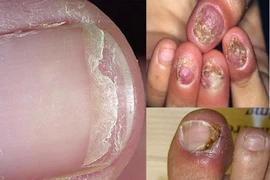 Cần kiên trì khi trị nấm móng