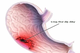 6 triệu chứng dự báo ung thư dạ dày thường bị bỏ qua