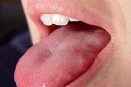 Vì sao bác sĩ khám bệnh hay xem lưỡi bệnh nhân?