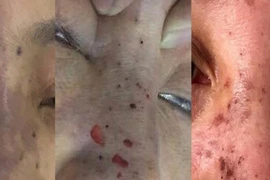 Bắt quả tang ‘bác sĩ' Hàn Quốc làm đẹp chui ở khách sạn