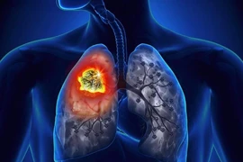 5 bệnh chết chóc ở nam giới thường phát hiện rất trễ