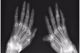 Dùng vàng khâu khớp tay để trị thấp khớp
