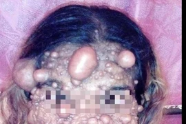 Người phụ nữ nổi u như bong bóng khắp người 