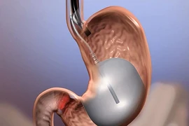 12 người chết do nuốt bóng vào bụng để giảm cân