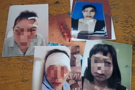 Tâm sự cay đắng của người vợ bị chồng cắt gân chân