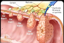 Các giai đoạn của ung thư đại tràng
