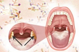 Những biến chứng nguy hiểm của bệnh bạch hầu