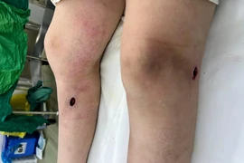  Đi spa làm đẹp, cô gái 20 tuổi xém hỏng cặp chân
