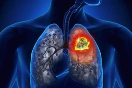 Ung thư phổi có di truyền?