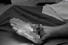 Đang cắt cỏ, người đàn ông bị đứt 2/3 bàn chân trái