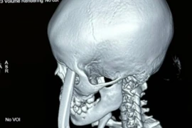 Báo động đỏ liên viện cứu bé gái bị tay thắng xe đạp đâm xuyên hốc mắt