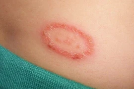 Hắc lào và lang ben là một hay hai bệnh?