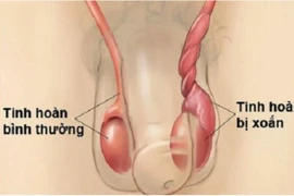 Bé trai phải cắt bỏ tinh hoàn sau cơn đau 5 ngày nhưng cố nhịn