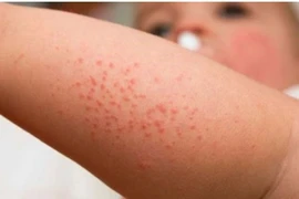 Trẻ mắc bệnh sởi có phải kiêng tắm?