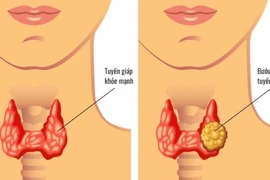 Bác sĩ ơi, cắt tuyến giáp có còn nói được nữa không?