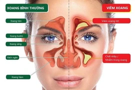 Những điều cần biết về viêm xoang