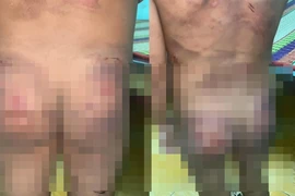 Khởi tố cha dượng và mẹ ruột hành hạ cháu bé 7 tuổi