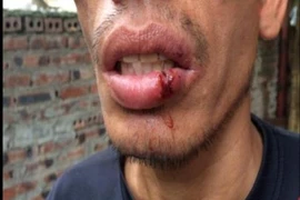 Sự thật về tin CSGT Hải Dương 'đánh người rách môi'
