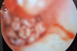 Hàng chục con giòi bên trong tai của bệnh nhân