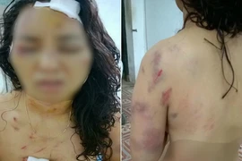 Cô giáo tiểu học bị chồng bạo hành dã man