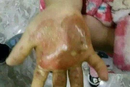 Mẹ đẻ nhúng tay con gái vào nước sôi, rắc muối vào vết thương