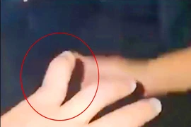 Công an xác minh vụ khách tố bị chủ quán cơm gà đánh gãy ngón tay 