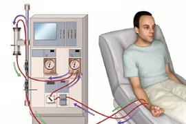 Bệnh nhân chạy thận nhân tạo dễ gặp những rủi ro nào?