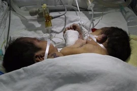 Hai bé sơ sinh dính liền ở Hà Giang đã mất