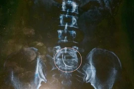 Cảnh cáo bác sĩ để kim trong bụng bệnh nhân chín năm