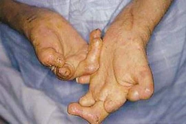 TP.HCM sẽ loại trừ bệnh phong trong năm nay