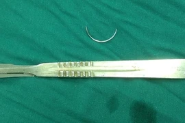 Lấy cây kim nằm trong bụng bệnh nhân suốt 15 năm