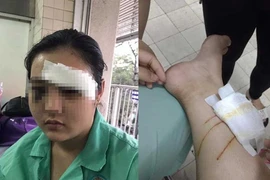 Cô gái 16 tuổi bị đánh có khả năng hỏng 1 mắt