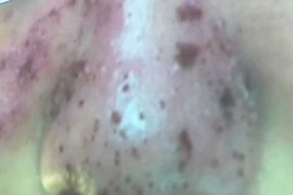 Liều mạng đi thẩm mỹ, mặt chi chít 'hố bom'