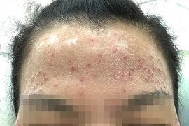 ‘Sát thủ’ làn da mang tên… corticosteroid!