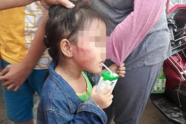 Bình Chánh: Cô giáo đánh trẻ nứt xương hàm