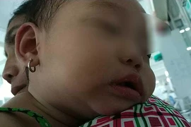 Kawasaki, bệnh lạ nguy hiểm