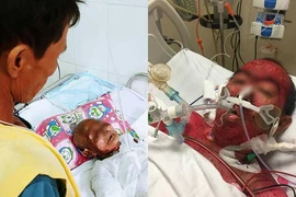 Suy thận nặng, hoại tử sau khi uống thuốc cảm sốt