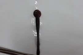 Chảy máu mũi 10 ngày, đến BV được bác sĩ gắp ra con đỉa