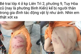 Công an xác minh vụ bé trai bị bạo hành bầm tím người