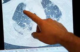 Khám phá gene liên quan việc nhân đôi nguy cơ tử vong do COVID-19