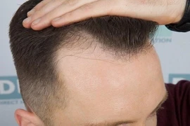 Thủ phạm gây ra chứng hói đầu